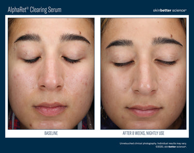 AlphaRet® Clearing Serum