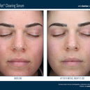 AlphaRet® Clearing Serum