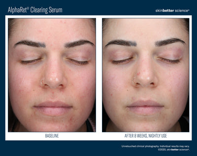 AlphaRet® Clearing Serum