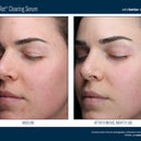 AlphaRet® Clearing Serum
