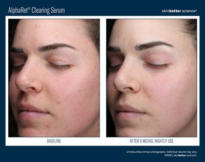 AlphaRet® Clearing Serum