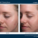 AlphaRet® Clearing Serum