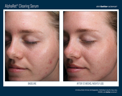 AlphaRet® Clearing Serum
