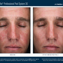AlphaRet® Professional Peel System 30