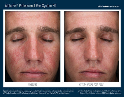 AlphaRet® Professional Peel System 30