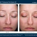 AlphaRet® Professional Peel System 30