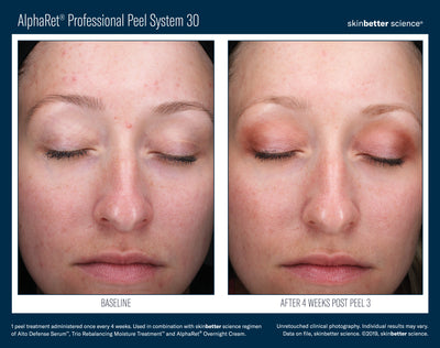 AlphaRet® Professional Peel System 30