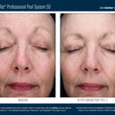 AlphaRet® Professional Peel System 50