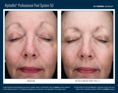 AlphaRet® Professional Peel System 50