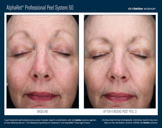 AlphaRet® Professional Peel System 50