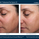 AlphaRet® Professional Peel System 50