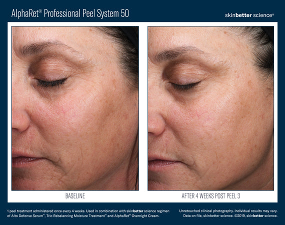 AlphaRet® Professional Peel System 50