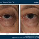 InterFuse® Intensive Treatment EYE