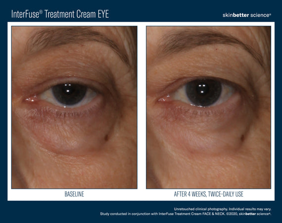 InterFuse® Intensive Treatment EYE