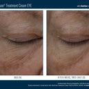 InterFuse® Intensive Treatment EYE