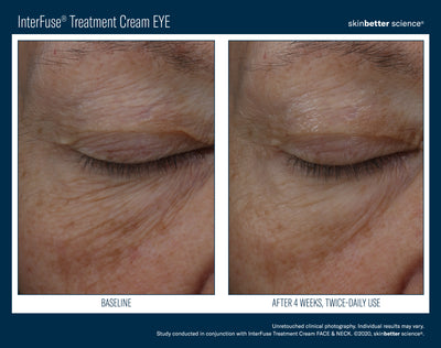 InterFuse® Intensive Treatment EYE