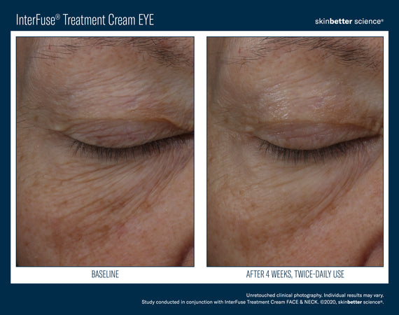 InterFuse® Intensive Treatment EYE