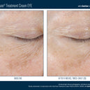 InterFuse® Intensive Treatment EYE