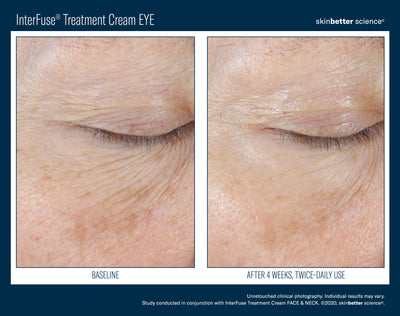 InterFuse® Intensive Treatment EYE