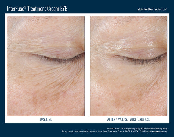 InterFuse® Intensive Treatment EYE