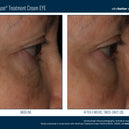 InterFuse® Intensive Treatment EYE