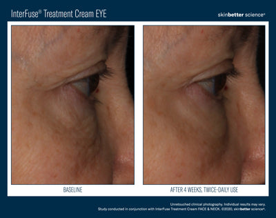 InterFuse® Intensive Treatment EYE