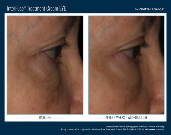InterFuse® Intensive Treatment EYE