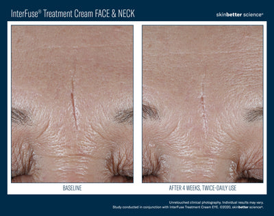 InterFuse® Treatment Cream FACE & NECK