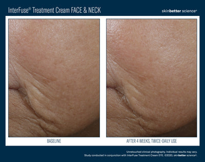 InterFuse® Treatment Cream FACE & NECK