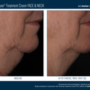 InterFuse® Treatment Cream FACE & NECK
