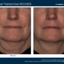 InterFuse® Treatment Cream FACE & NECK