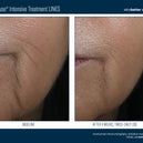 InterFuse® Intensive Treatment LINES