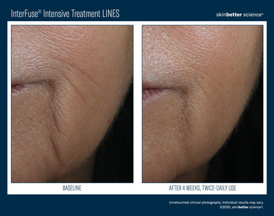 InterFuse® Intensive Treatment LINES