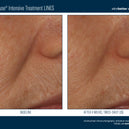 InterFuse® Intensive Treatment LINES