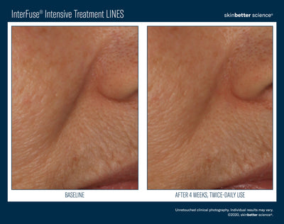 InterFuse® Intensive Treatment LINES