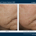 InterFuse® Intensive Treatment LINES