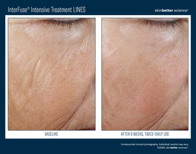 InterFuse® Intensive Treatment LINES