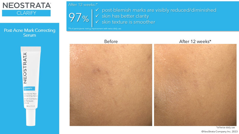 NEOSTRATA® Clarify Post-Acne Mark Correcting Serum