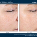 AlphaRet® Exfoliating Peel Pads (30 Pads)