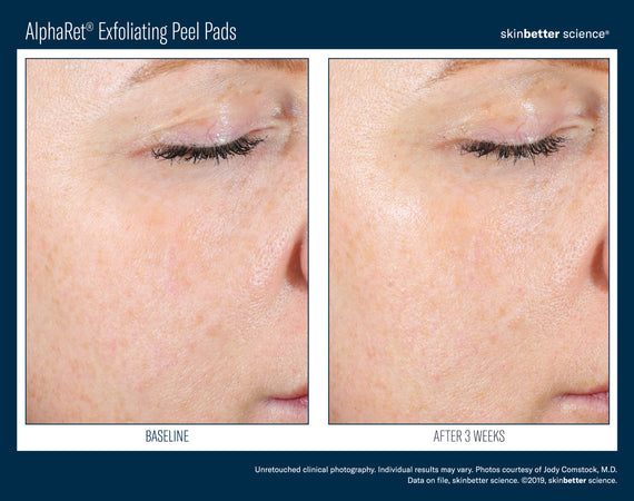 AlphaRet® Exfoliating Peel Pads, 30 Peel Pads