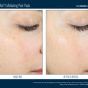 AlphaRet® Exfoliating Peel Pads (30 Pads)