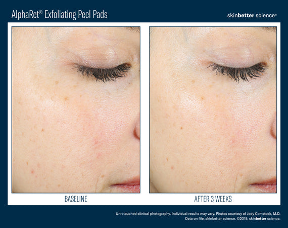 AlphaRet® Exfoliating Peel Pads, 30 Peel Pads