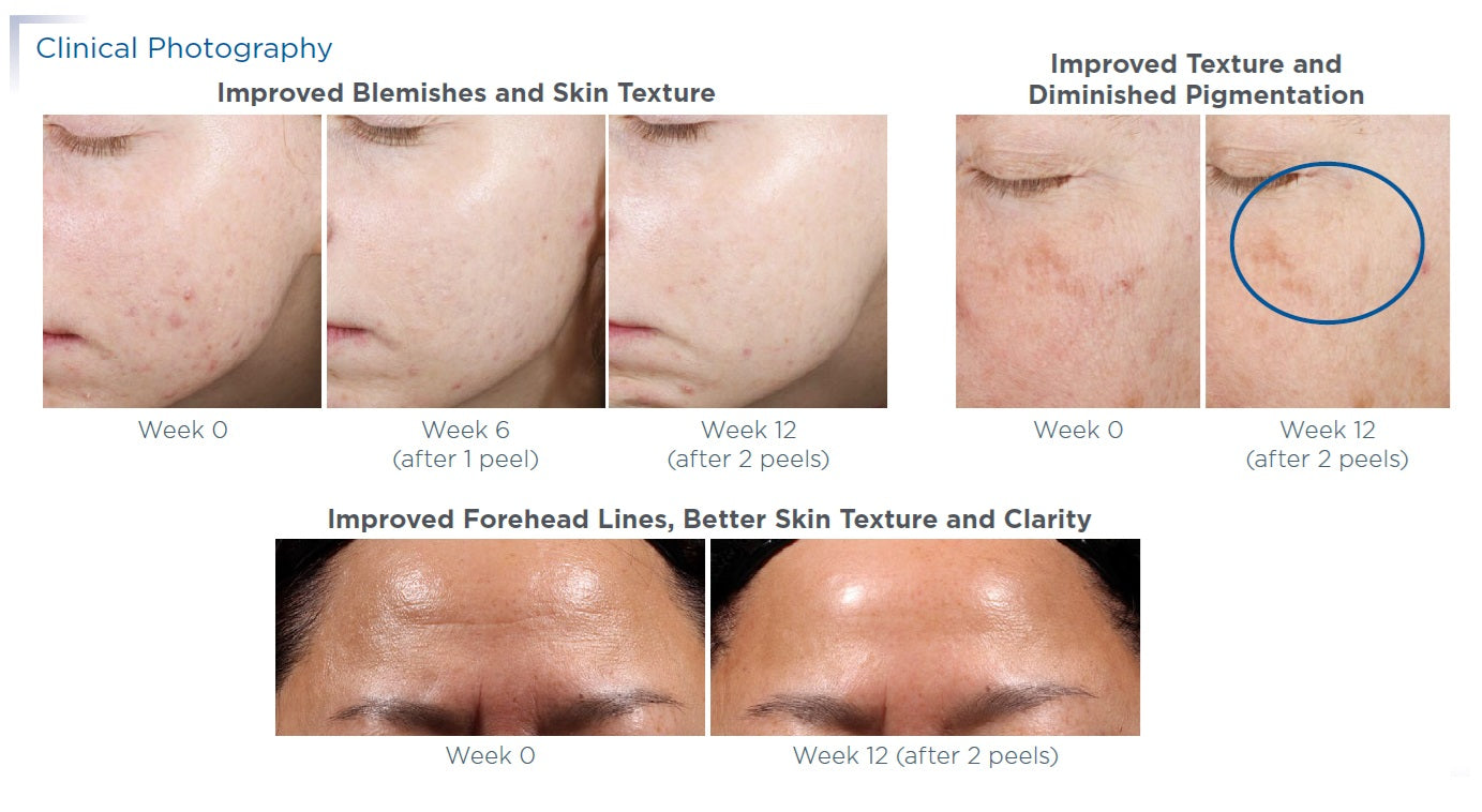 ProSystem Retinol Peel 12 vials 1.5ml – AestheticSource